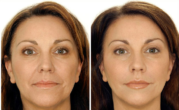 Аппарат Asclepion MCL 31 Dermablate