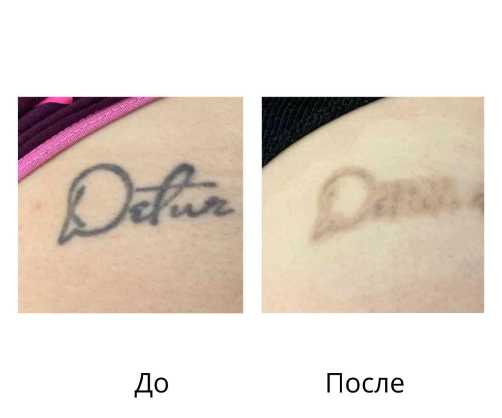 Лазерное удаление