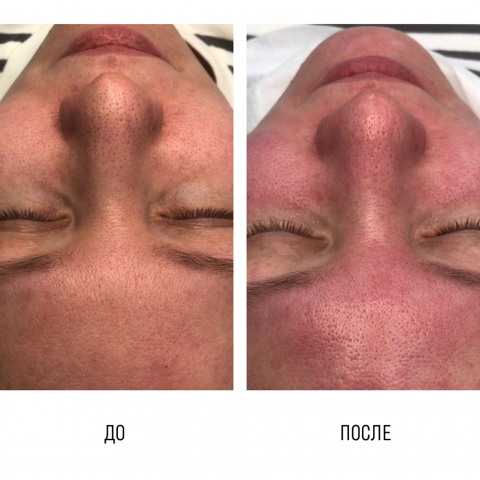 Дерматологическая чистка лица