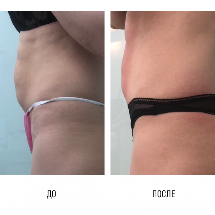 Курс процедур "Энедосфера терапия"