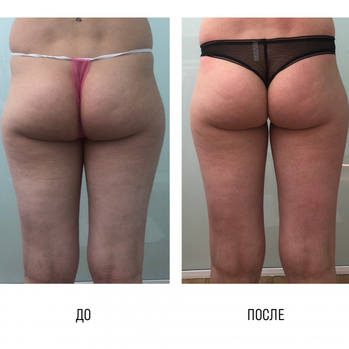 Курс процедур "Энедосфера терапия"