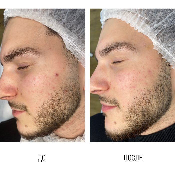 Дерматологическая чистка лица + плазмотерапия