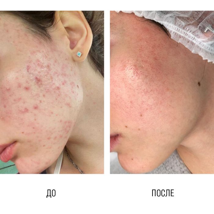 Комплексное лечение акне