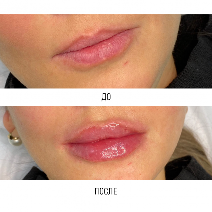 Контурная пластика губ