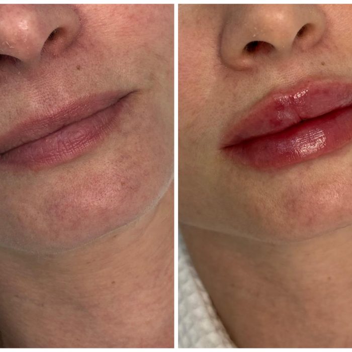 Контурная пластика губ, врач Луковкина А.А.