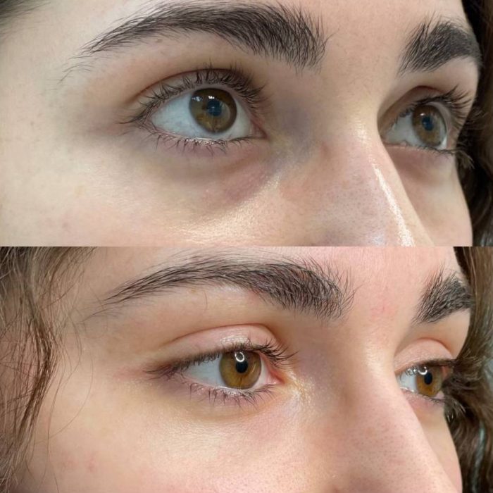 Коррекция носослезной борозды