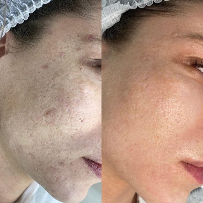 Фракционный фототермолиз (лазерная шлифовка)