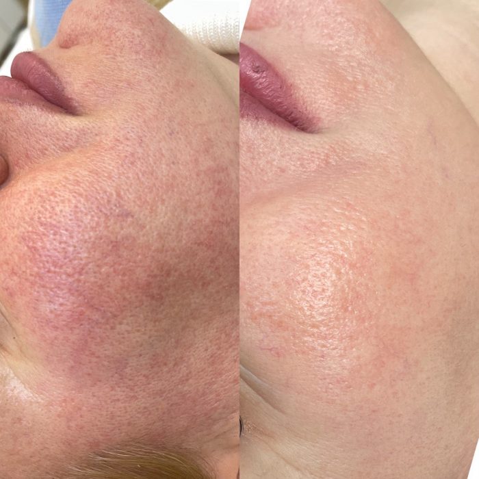 Лечение розацеа