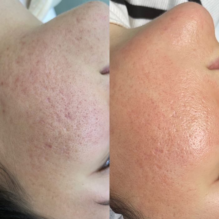 Фракционный фототермолиз (лазерная шлифовка)