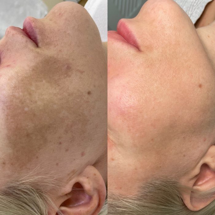 Лечение пигментации