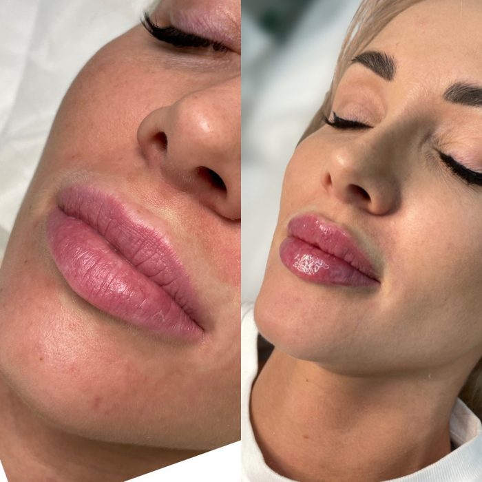 Контурная пластика губ