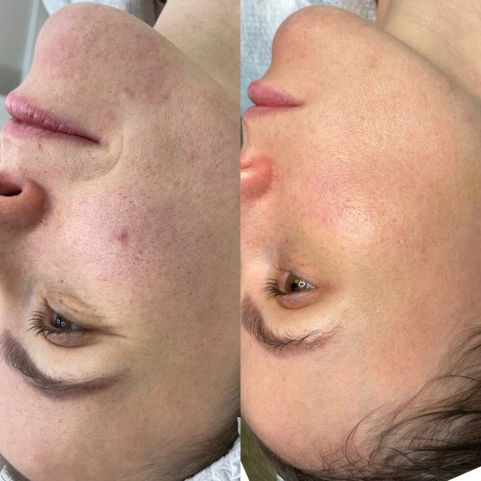 Фракционный фототермолиз (Лазерная шлифовка) Halo