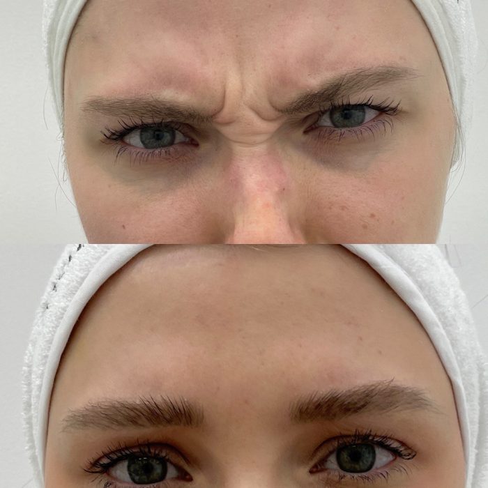 Ботулинотерапия