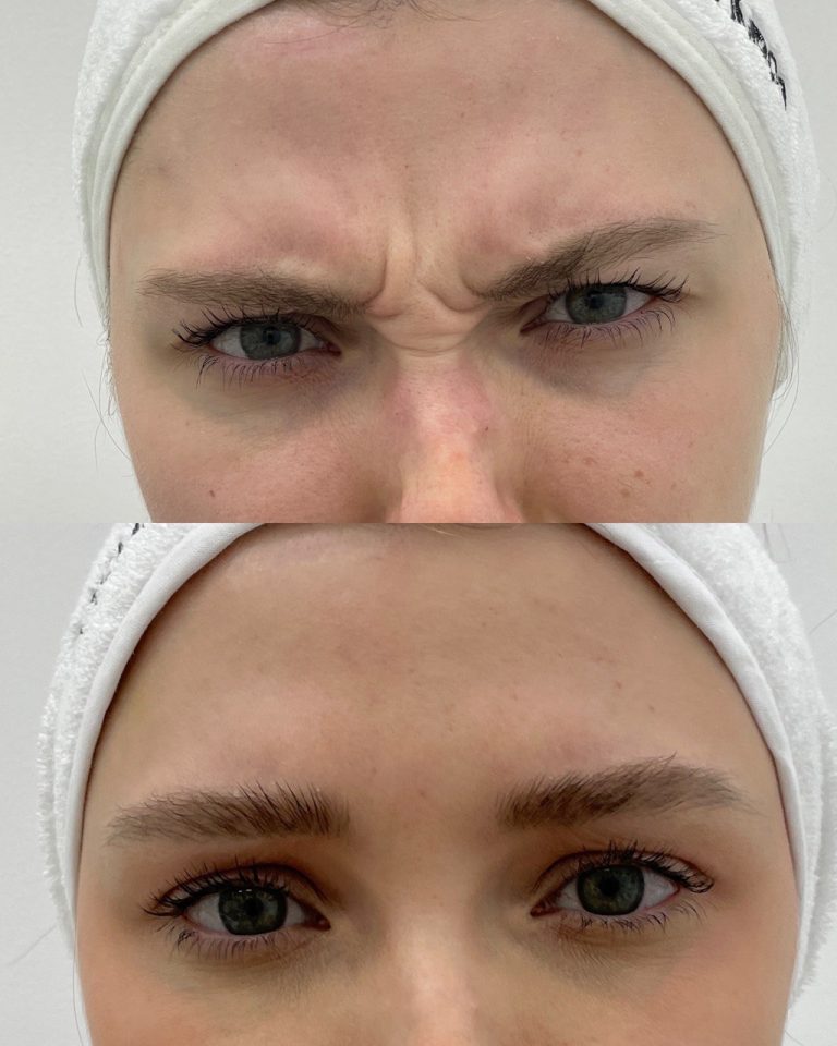 Ботулинотерапия