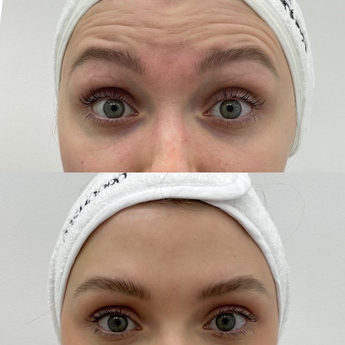 Ботулинотерапия