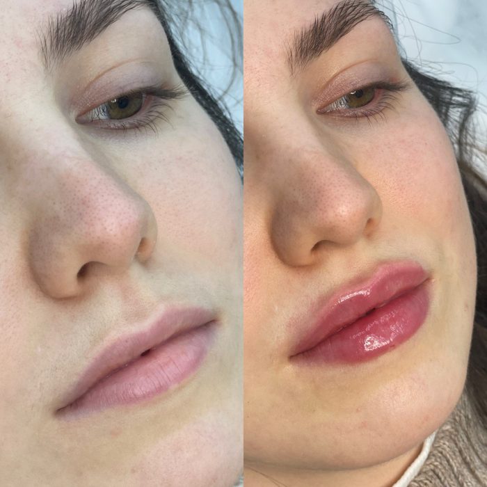 Контурная пластика губ