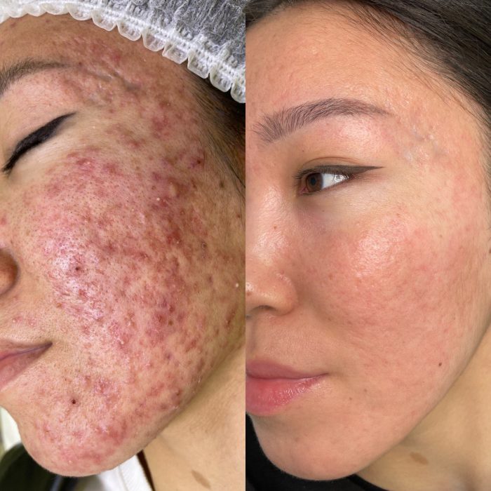 Комплексное лечение акне