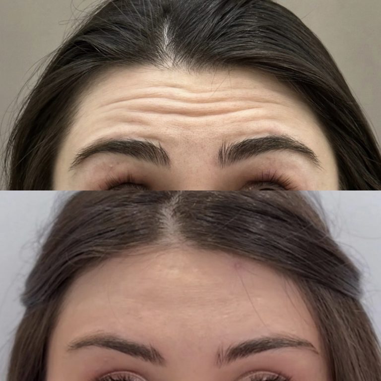 Ботулинотерапия