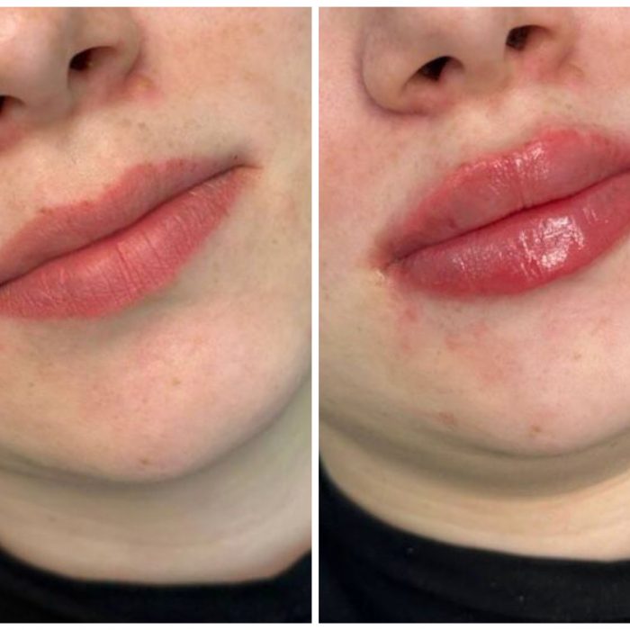 Контурная пластика губ, врач Луковкина А.А.