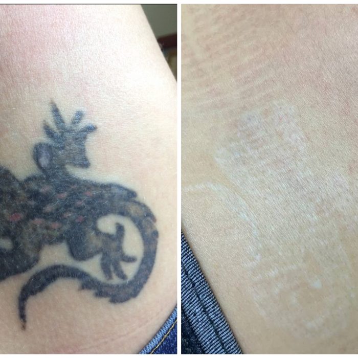 Удаление тату лазером (6 процедур) + Лазерная шлифовка (1 процедура)