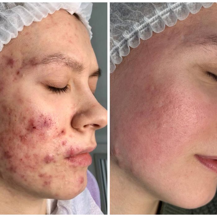 Комплексное лечение акне + Лазерная шлифовка