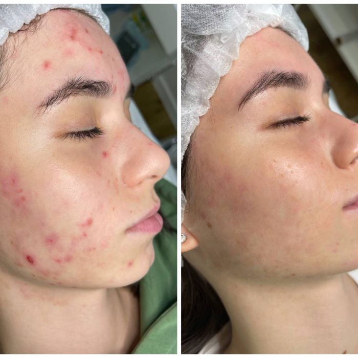 Лечение эскориированного акне