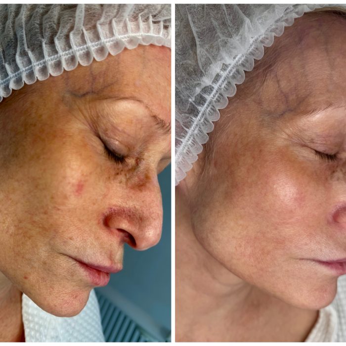 Аnti-age коррекция