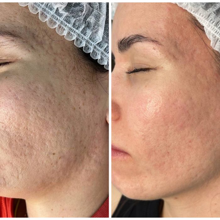 Фракционный фототермолиз (Лазерная шлифовка)