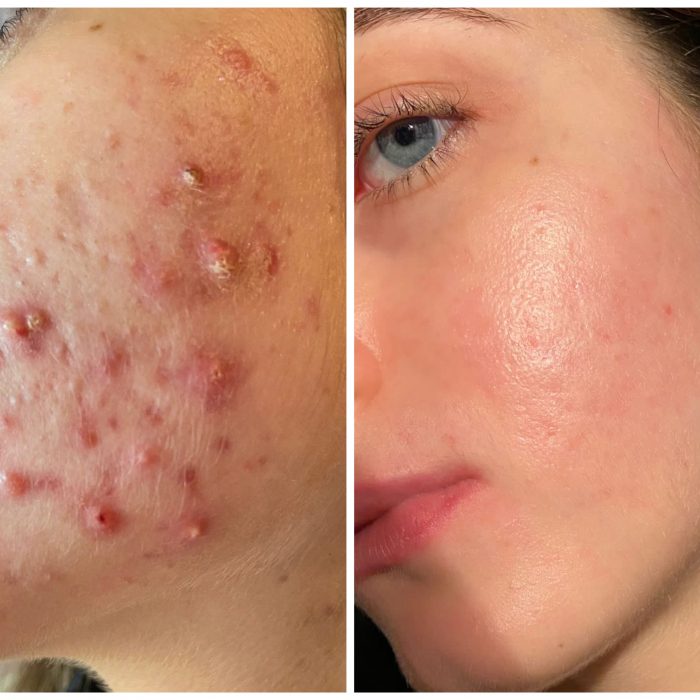 Комплексное лечение акне - дистанционно