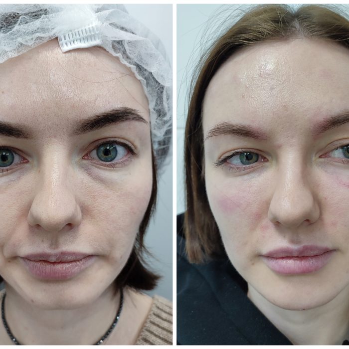 Контурная пластика FullFace и комплексное омоложение