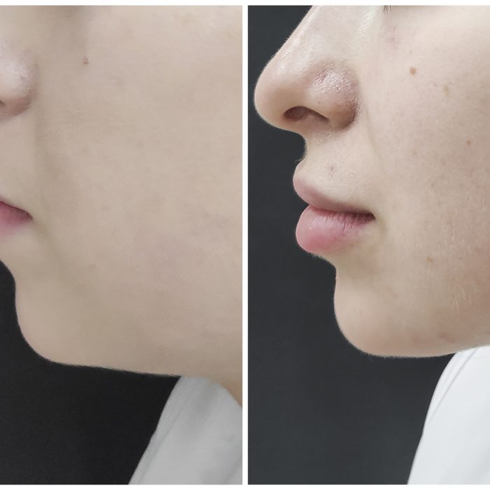 Комплексный лифтинг овала лица