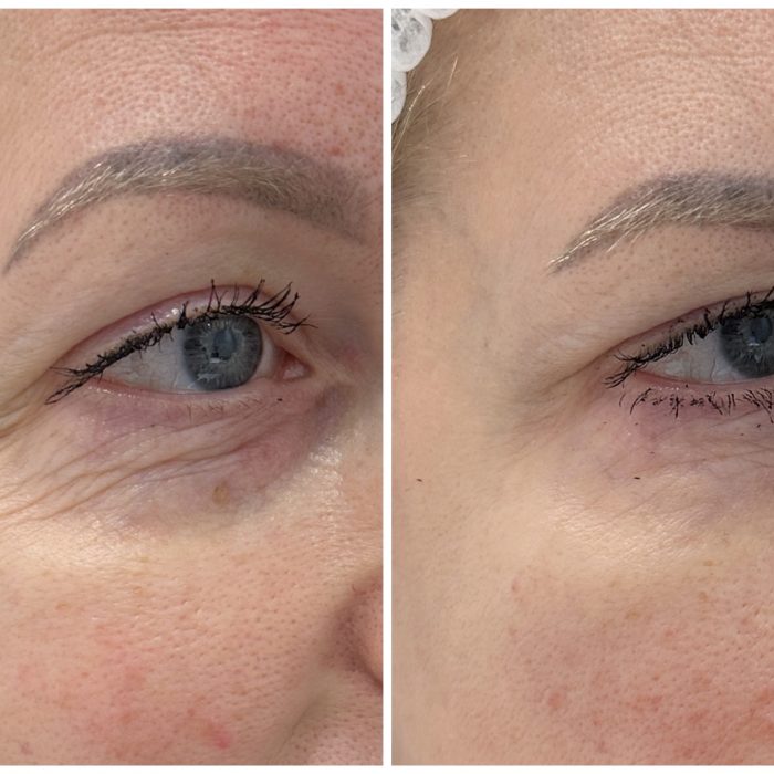 Омоложение кожи вокруг глаз