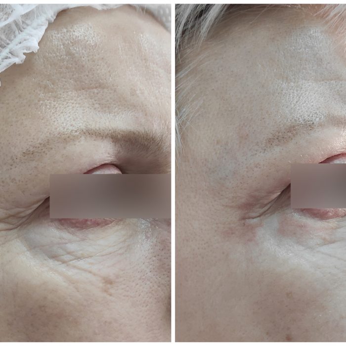 Омоложение кожи вокруг глаз