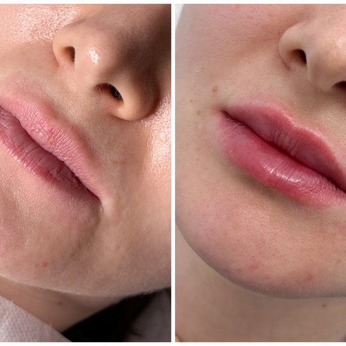 Контурная пластика губ