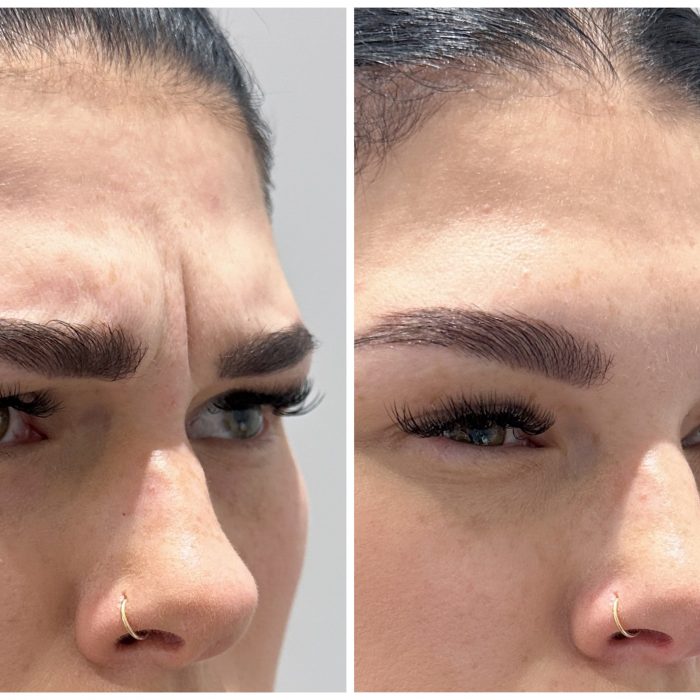 Ботуинотерапия морщины межбровья