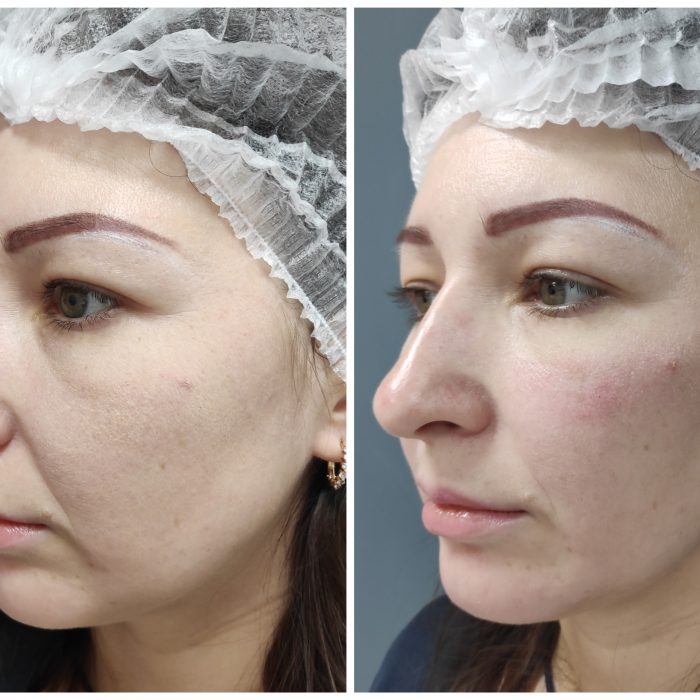 Контурная пластика FullFace