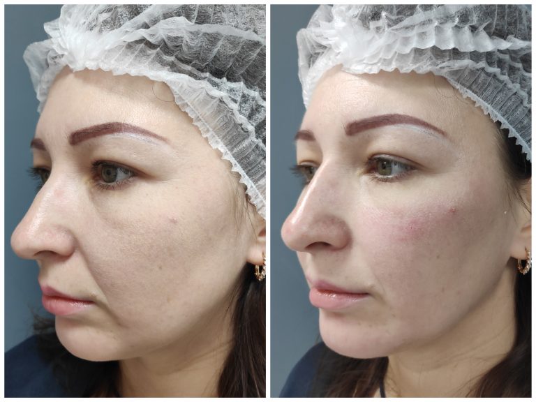 Контурная пластика FullFace