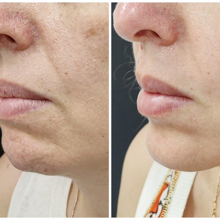 Ботулинотерапия овала лица и подбородка