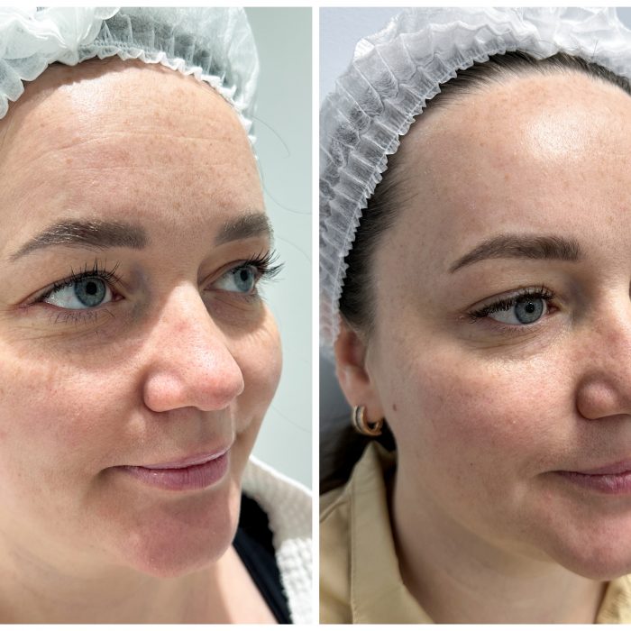 Комплексная коррекция морщин (Только лоб)