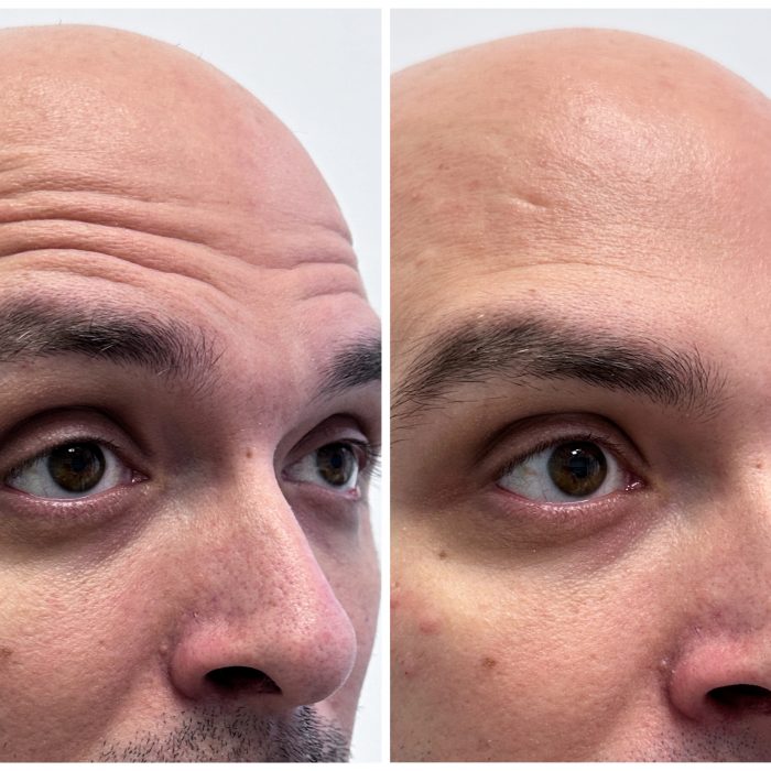 Коррекция морщин (Только лоб)