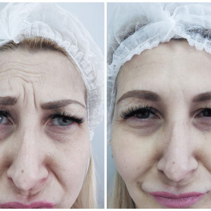 Устранение морщин лба и межбровья (Только верхняя треть лица)