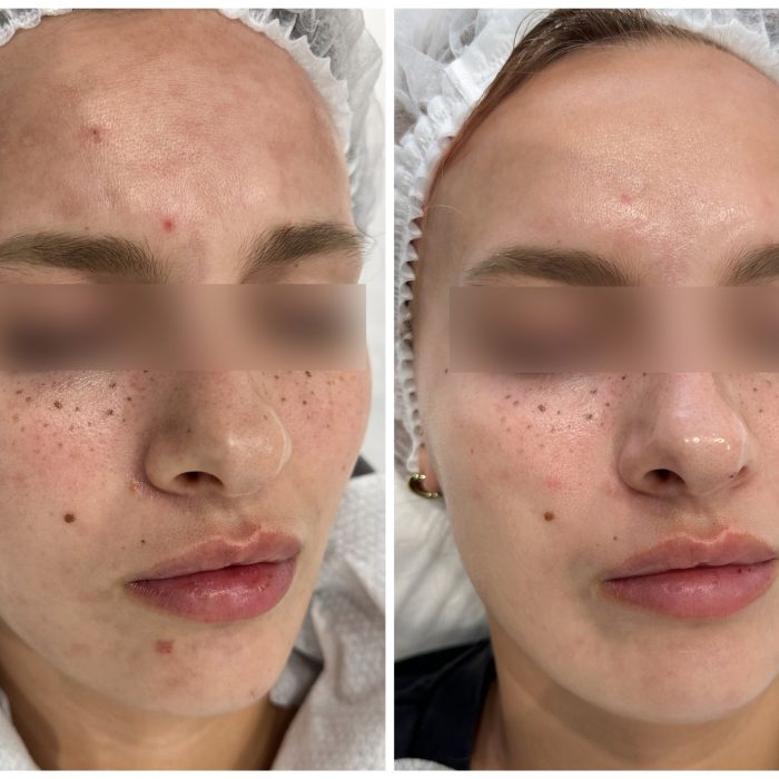 Комплексная коррекция пигментации (Только лоб)