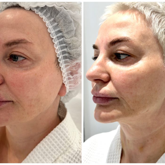 Нитевой лифтинг овала лица (Овал лица)