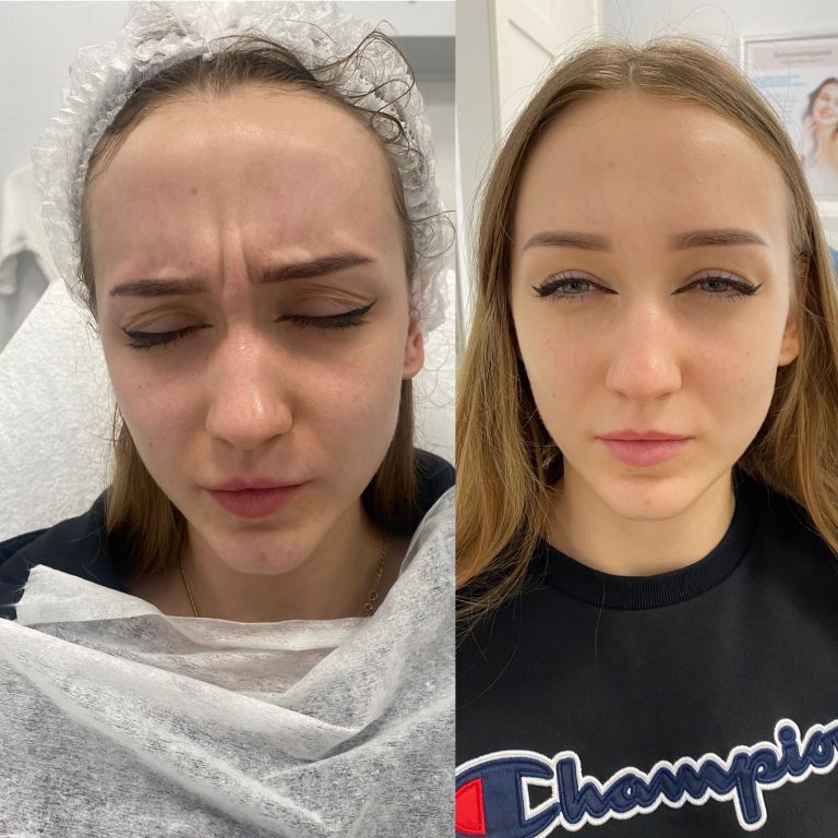 Ботулинотерапия