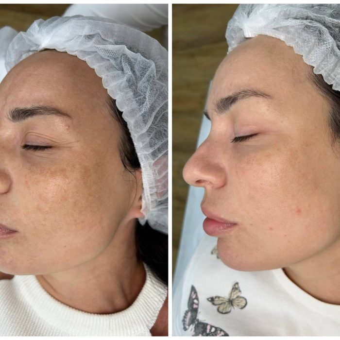 Фракционный фототермолиз на аппарате  LaseMd