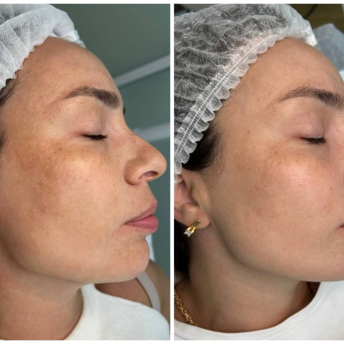 Фракционный фототермолиз на аппарате  LaseMd