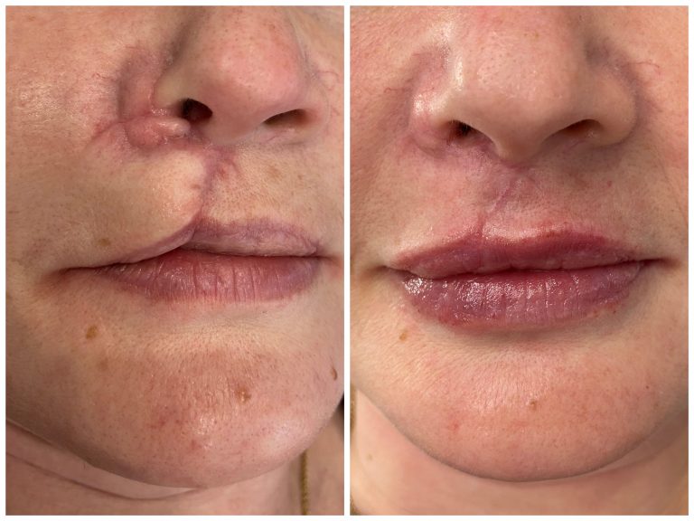 Комплексное устранение рубца