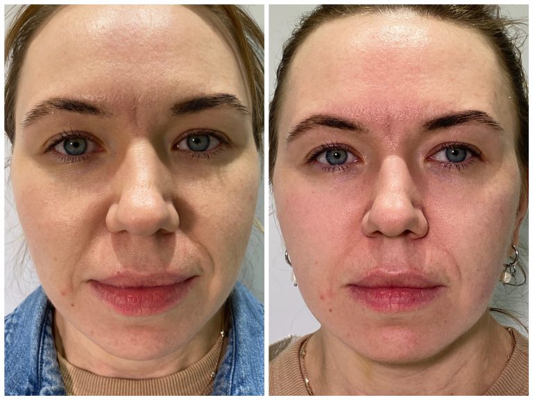 Безоперационная подтяжка овала. SMAS-лифтинг Ultraformer MPT