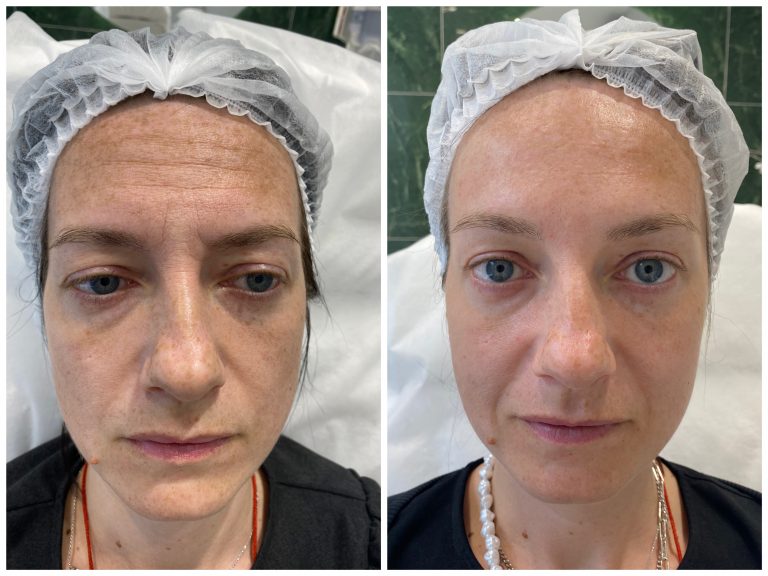 Коррекция морщин. Ботулинотерапия FullFace
