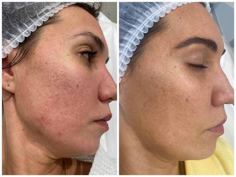 Игольчатый RF-лифтинг